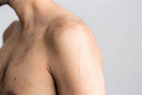 shoulder alchetron   social encyclopedia