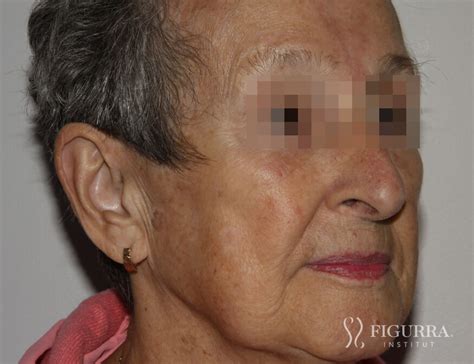 Seborrheic Keratosis - Institut Figurra