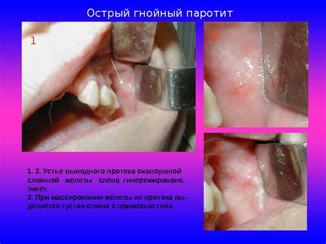 Анатомия слюнных желез Воспалительные заболевания слюнных желез