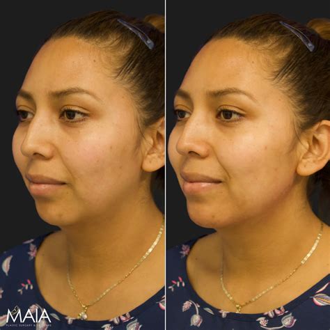 Jawline Filler | Maia Plastic Surgery