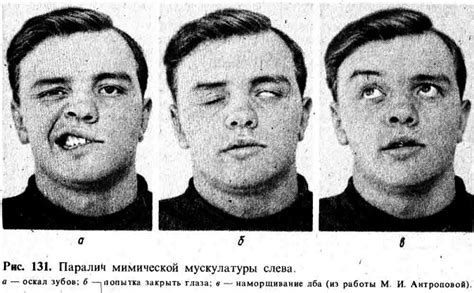 Неврит лицевого нерва: симптомы, лечение, фото, последствия