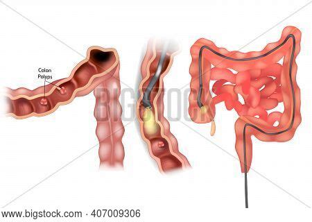 Removal Polyps Colon Vector & Photo (Free Trial) | Bigstock