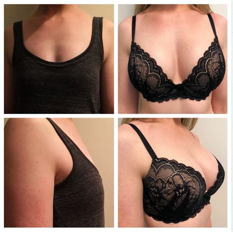 breast augmentation  rescu