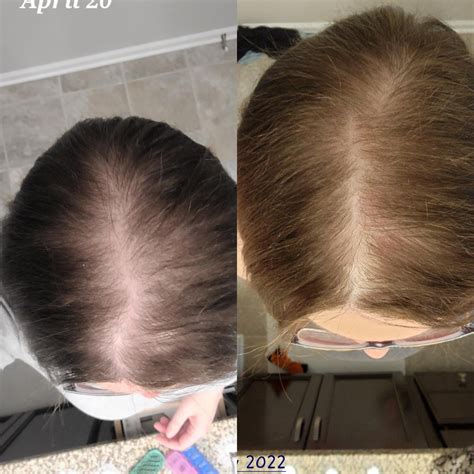 Spironolactone for hair loss?!? : r/FemaleHairLoss