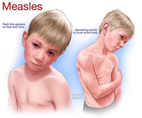 Measles Can Almost Always be Prevented With a Vaccine - Mayo Clinic