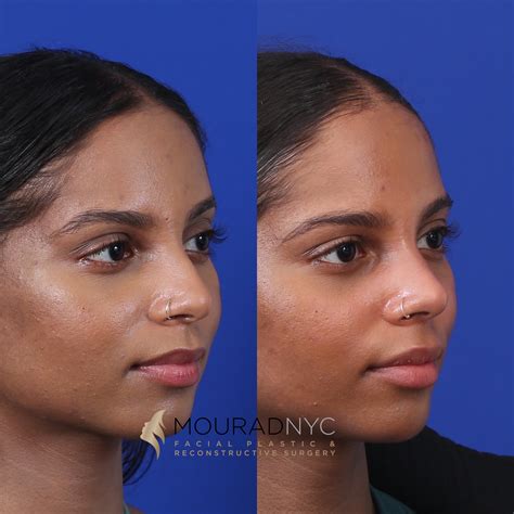Before and After Female Closed Rhinoplasty | Facial Plastic Surgeon