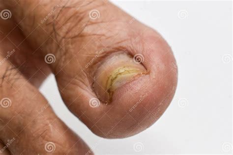 Fungal Nail Infection. Onychomycosis, Also Called Tinea Unguium Stock ...