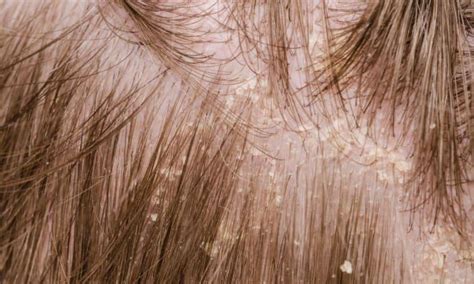 Itchy Scalp Causes And Treatment
