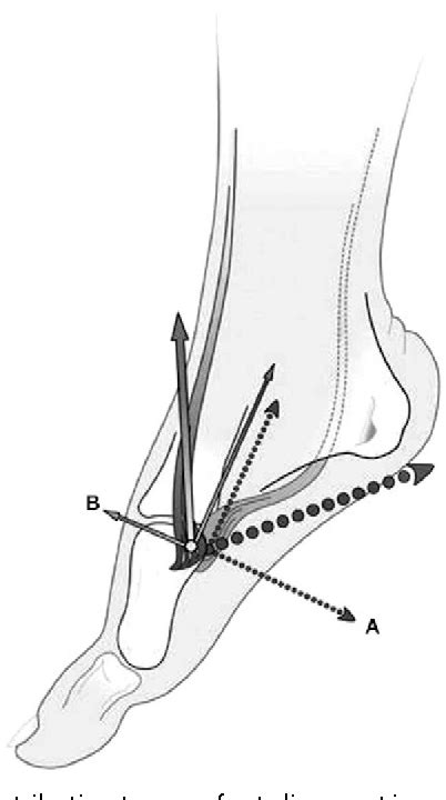 Figure 9 from The cavus foot. | Semantic Scholar