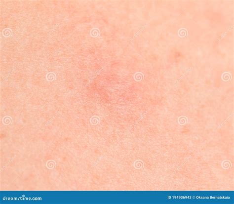Red Spots on the Skin from the Sun Stock Image - Image of spots ...
