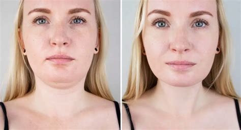 Double Chin Removal: Causes, Prevention, Treatment | Dr. Donath