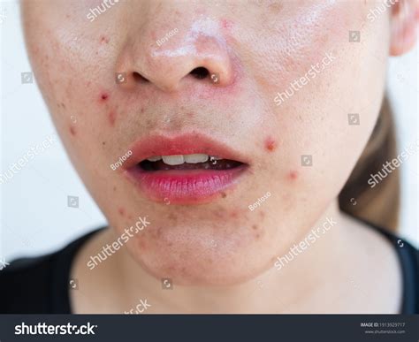 958 Inflamed Acne Images, Stock Photos & Vectors | Shutterstock