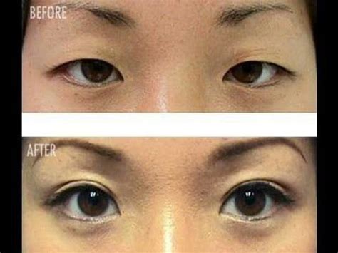 Monolid Vs Double Eyelid : 40003-Asian-Double-Eyelid-2 - 77P Gallery ...