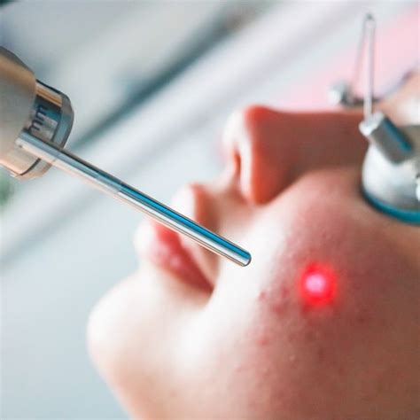 Acne laser – Artofit