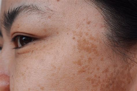 Melasma Treatment