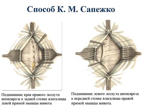 Топографическая анатомия и оперативная хирургия передней брюшной стенки ...