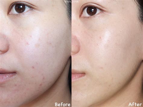 🥨N.รีวิวบ้างบางอารมณ์ on Twitter: "No1 ในใจเรื่องลดรอยเลย💓 Niacinamide ...
