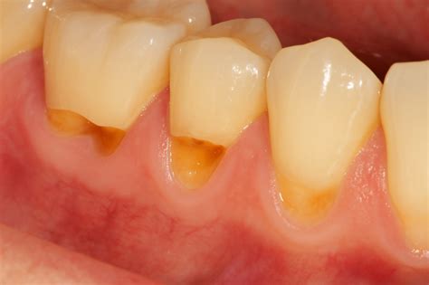 cervical abrasion