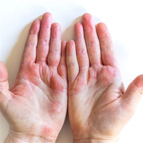 Understanding Eczema: Causes, Symptoms, and Treatments