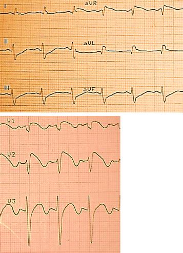 EKG (muestra elevación del segmento ST en las derivaciones V1-V3 con el ...
