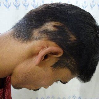 Hair regrowth after receiving three triamcinolone acetonide injections