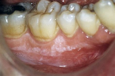 What Is White Spots On Your Mouth - Infoupdate.org