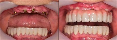 implant overdentures  fixed    treatment troy dental