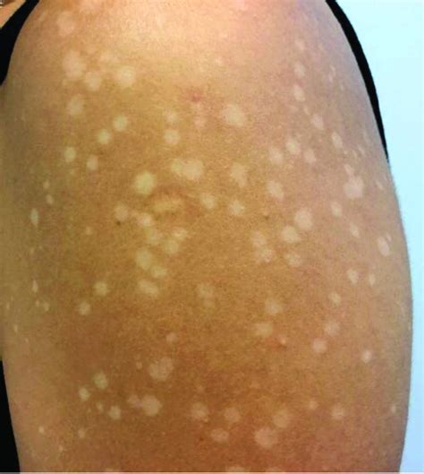 patch spots  skin  henry briggs blog