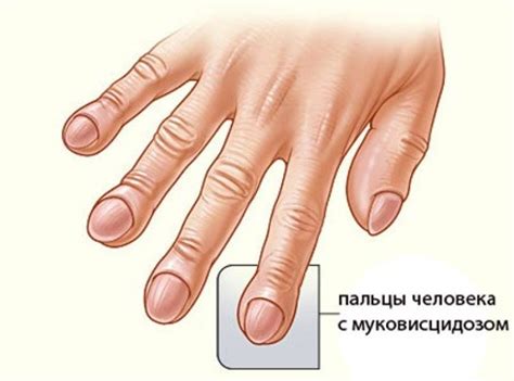Муковисцидоз - признаки, причины, симптомы, лечение и профилактика ...