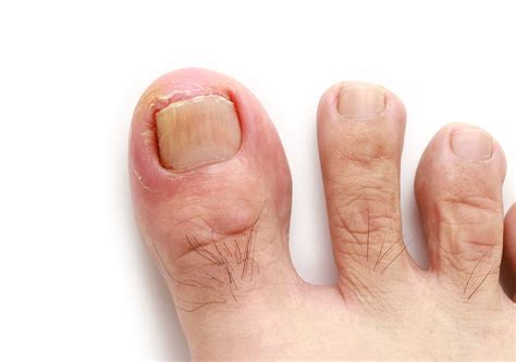 Ingrown Toenail Symptoms and Causes – Taylors Lakes Podiatry Clinic