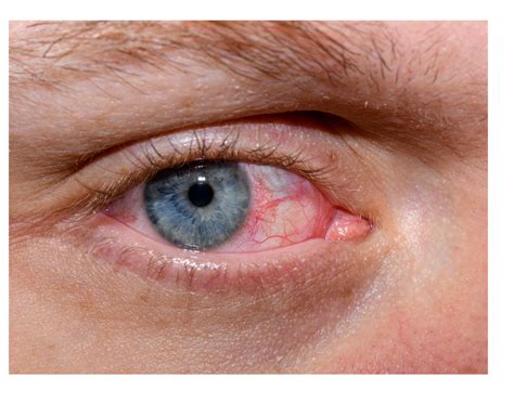 Understanding Viral Conjunctivitis: Symptoms, Causes, and Prevention