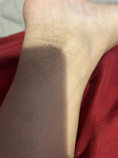 Does anyone with scleroderma have skin that looks like this? Waiting on
