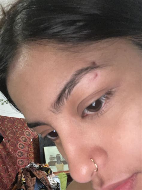Eyebrow Piercing Scar : r/scars