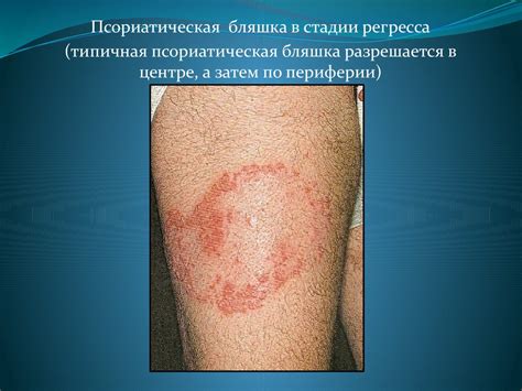 Псориаз. Красный плоский лишай - презентация онлайн