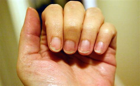 Yellow Skin On Hands