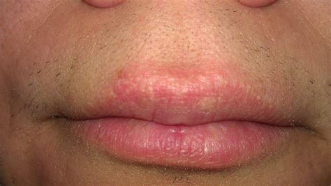 Small White Bumps On Upper Lip