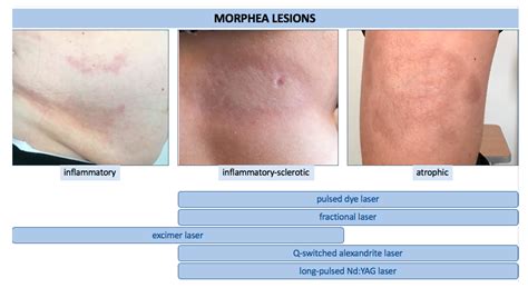 Morphea | Encyclopedia MDPI