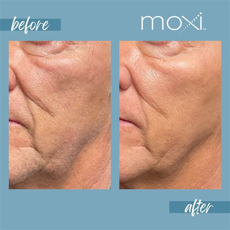 moxi face 2