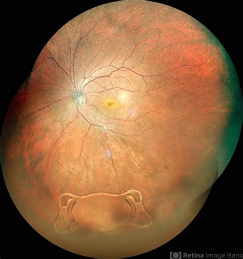IOL DROP - Retina Image Bank
