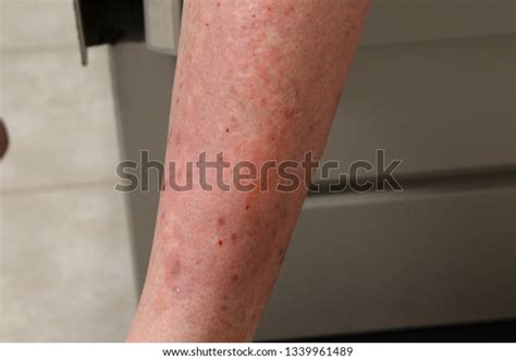 Dermatitis Herpetiformis Legs