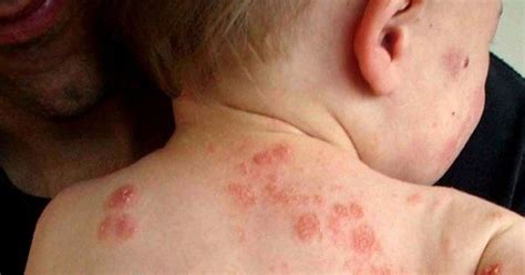 Средство от экземы! Естественное и дешевое средство от экземы! | Eczema ...