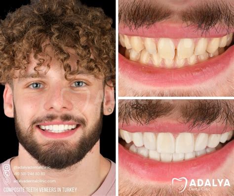 Turkey Teeth Veneers Before and After | Adalya Dental Clinic
