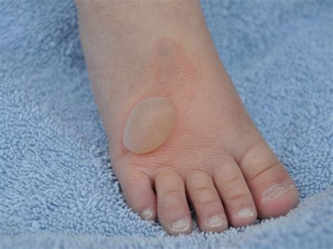 blisters  symptoms   remotederm