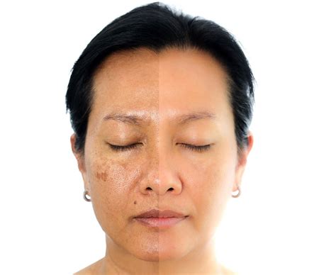 What Is Melasma? — SSDP