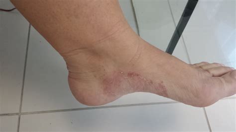 Sola Do Pé Amarelo O Que Pode Ser - Mancha Amarela Na Sola Do Pé - REVOEDUCA