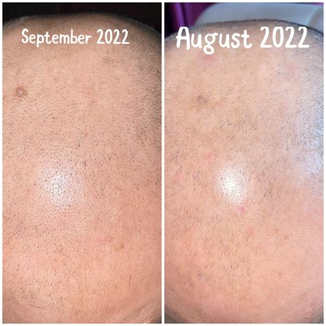 August 2022 to September 2022 (before and after) - minoxidil once a day ...