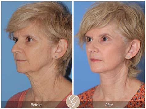 Deep Plane Facelifts Before & After Photos From Dr. Kevin Sadati