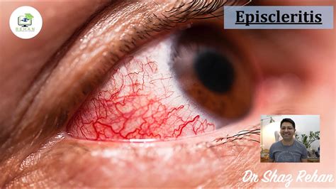 Episcleritis: What is it? How is it Diagnosed? How is it Treated I Dr ...