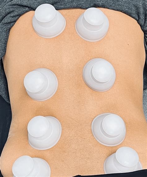 Benefits of Cupping Therapy — Texas Chiropractic Connection