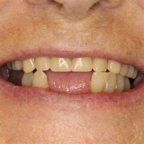 Partial Dentures Front Teeth
